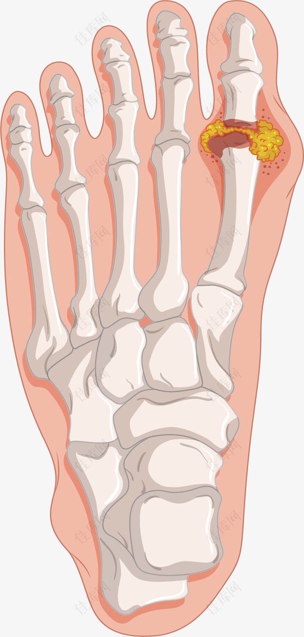 人体足部骨质增生